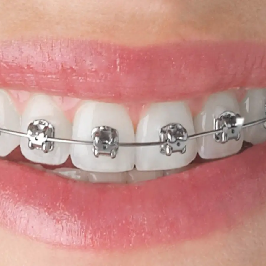 02 Autoligado Metálico