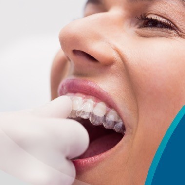 04 Alineadores Invisibles